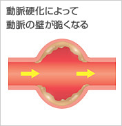 図:動脈硬化によって動脈の壁が脆くなる