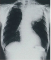 図:胸部レントゲン写真